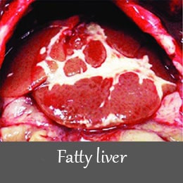 fatty-liver-1